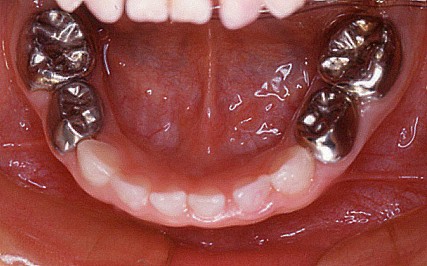 歯科用乳歯冠