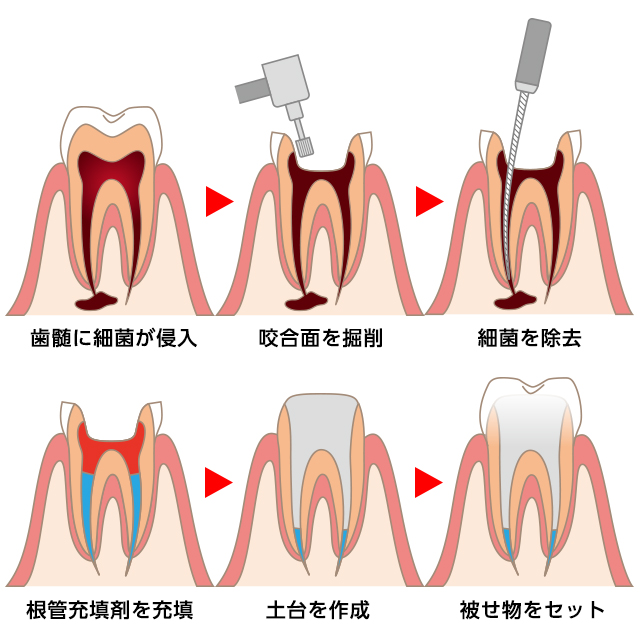 歯を残す「根管治療」のご提案